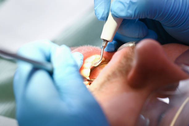 Best Emergency Dentist for Lost Fillings or Crowns in Tryon, NC